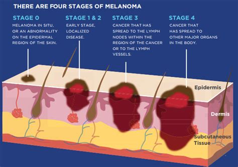 melanoma cancer stage 4 life expectancy